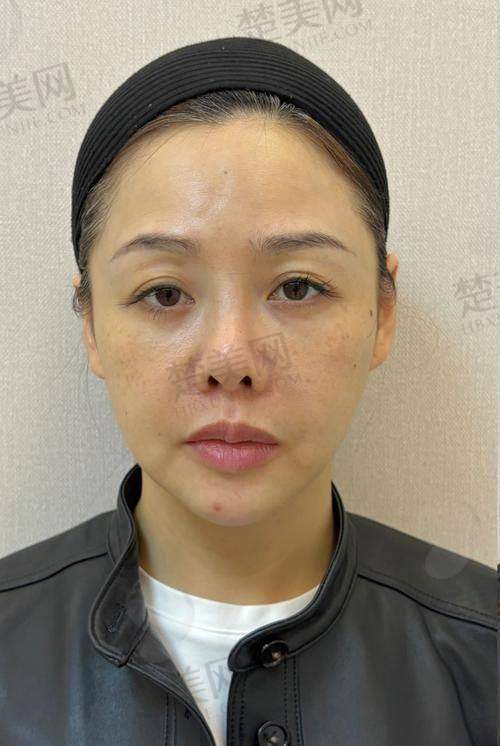 六、眼窝凹陷填充对比图的启示