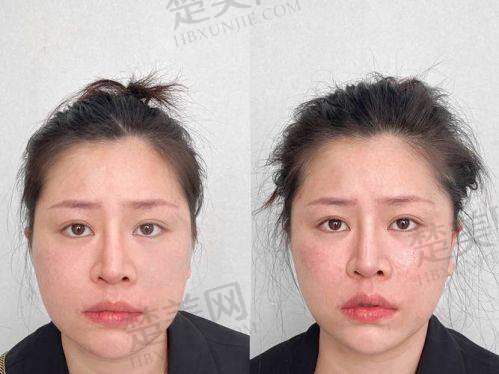 四、40岁女士眼窝凹陷填充的过程与成效