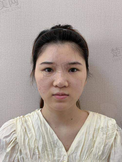 六、上海海华医院医疗美容——上海玻尿酸填充性价比之选