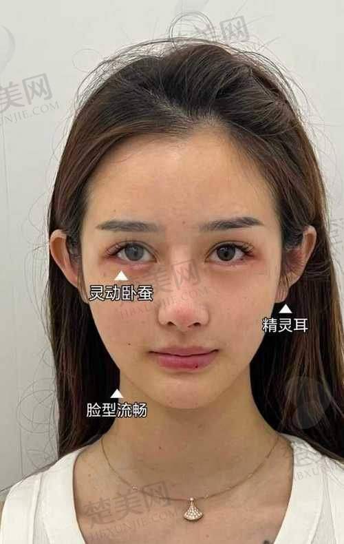 三、脂肪面部填充的修复阶段