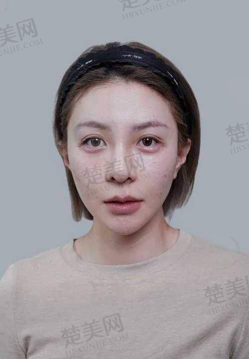六、脂肪面部填充后的长期成效