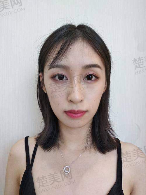 二、影响脂肪面部填充修复时间的因素