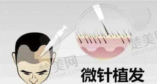 一、重庆万州植发——实力强劲的植发机构