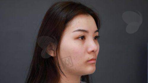 二、广州肖强医生做鼻子的技术优势
