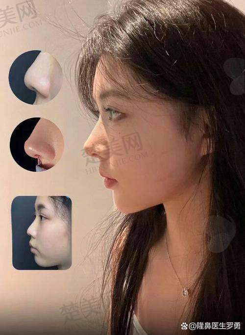 二、百家丽王滨福医生隆鼻优势剖析