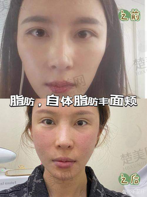 三、影响面部脂肪填充价格的因素