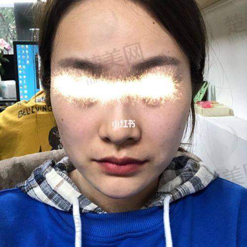 二、面部脂肪填充价格的大致范围