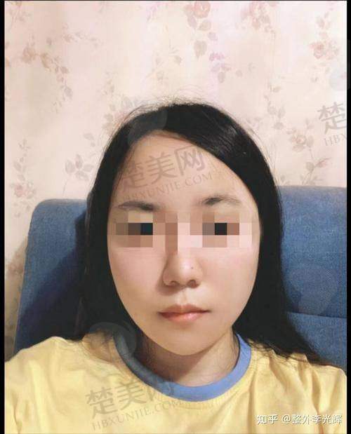 五、面部脂肪填充的注意事项