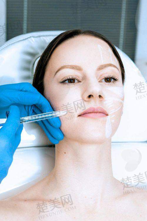 二、去除法令纹的好办法之分型治疗