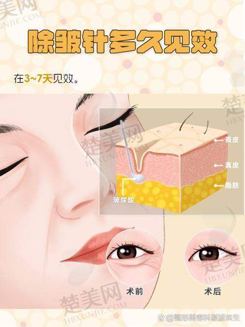 三、乔雅登玻尿酸不同系列的特点及适用部位