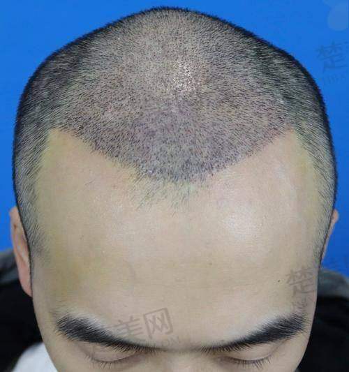 二、成都其他优质植发机构