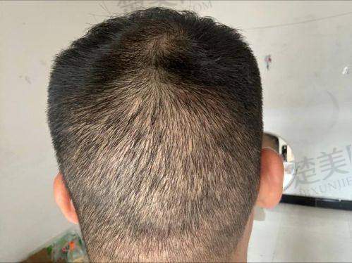 三、沈阳牛大夫植发诊疗项目有哪些？