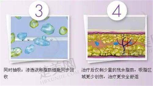 五、选择北京华韩整形医院精灵耳医生的好处
