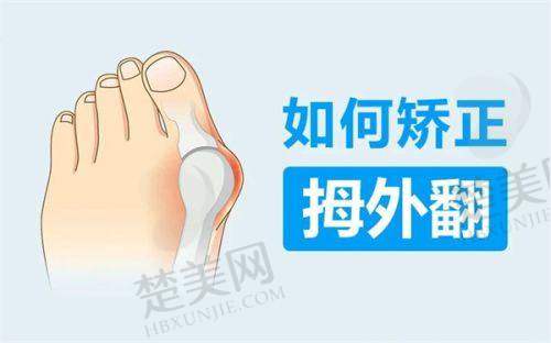 三、拇外翻手术费用情况