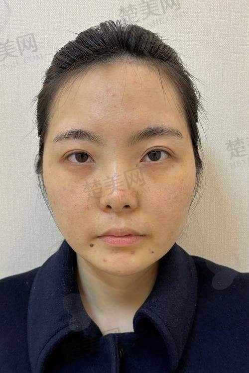 二、影响玻尿酸溶解成效的因素