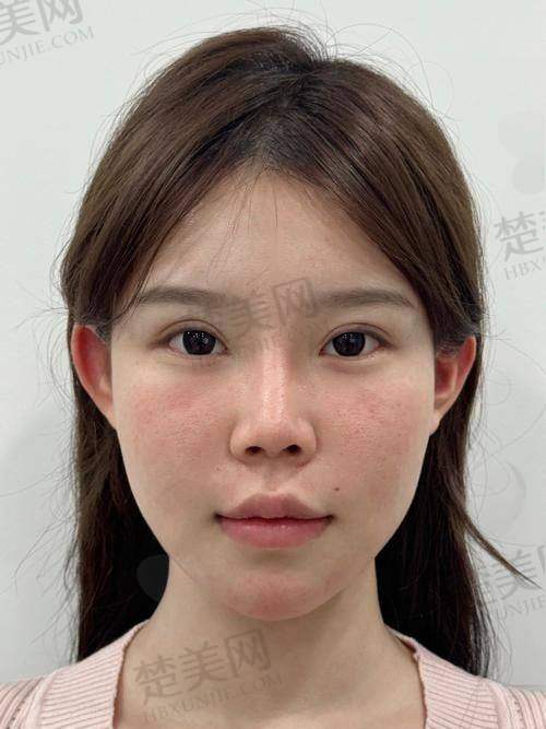 一、玻尿酸能否溶解的基本情况