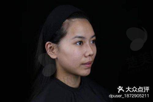 五、填充下巴手术后的注意事项