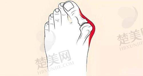 一、沈阳市骨科医院：大脚骨手术的专精之选