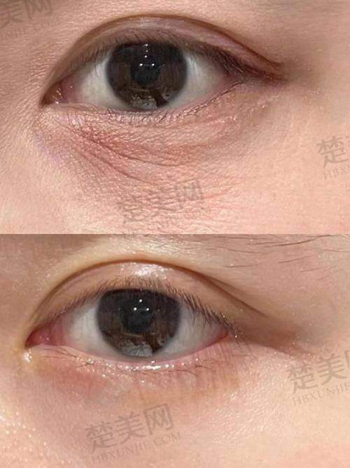 一、美容填充玻尿酸的基本介绍