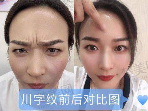 三、美容填充玻尿酸的适用部位