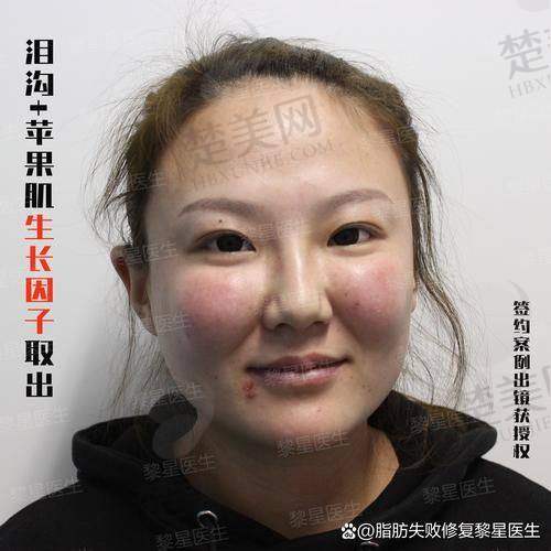 （二）埋线提升