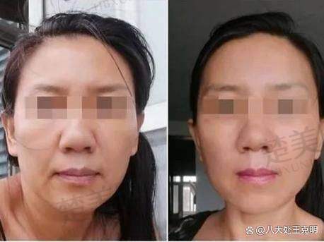 二、常见的苹果肌提升复位方式及费用