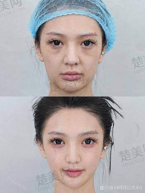 （一）注射填充苹果肌