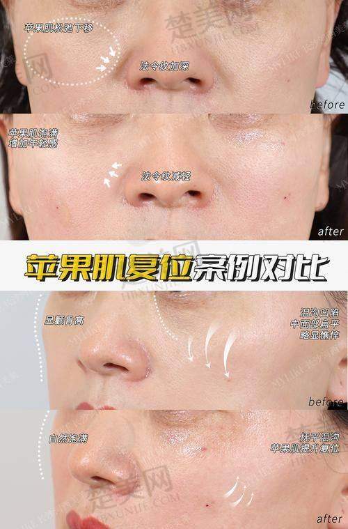 1. 玻尿酸注射