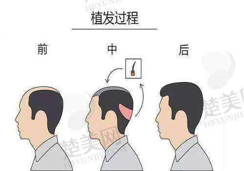 六、选择毛发种植手术的注意事项