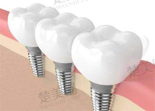 一、福鼎优贝口腔种牙怎么样
