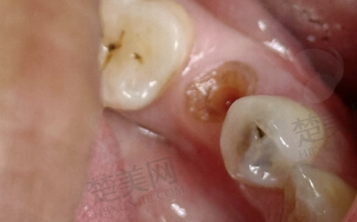 二、上海新菲口腔种植牙技术牛在哪