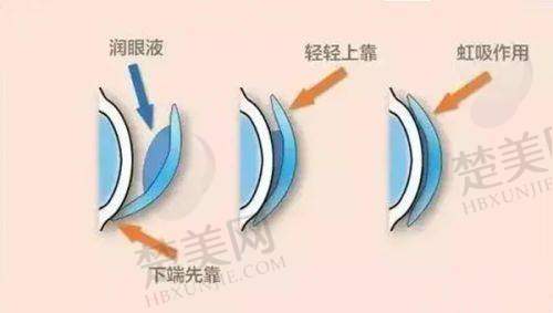 二、宁夏朝聚开明眼科医院近视手术技术优势
