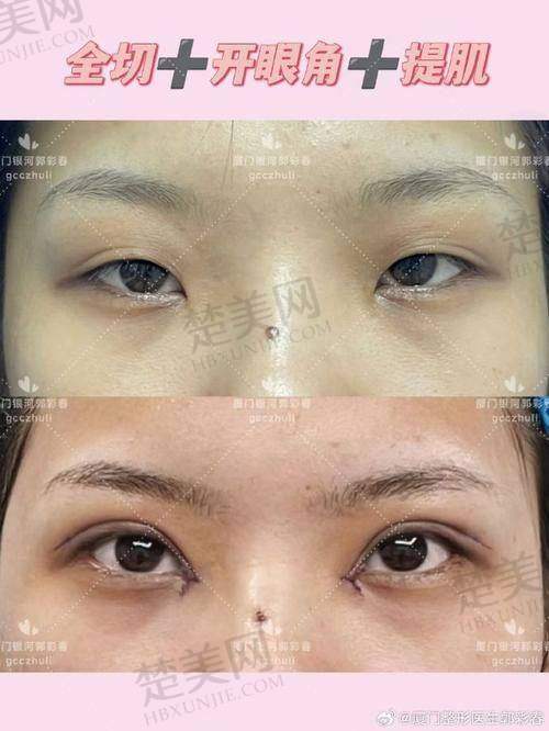 三、眼王刘志刚眼部整形口碑好不好