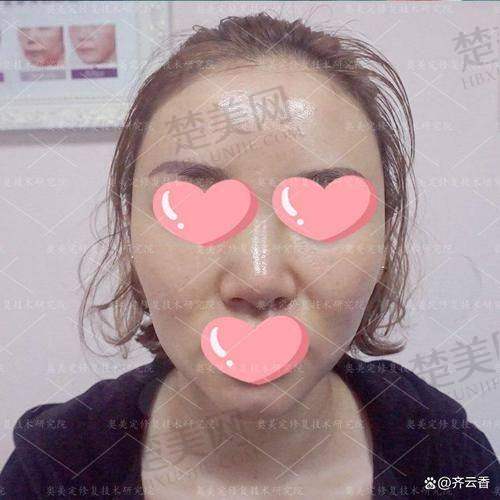 一、注射填苹果肌的目的和适用人群