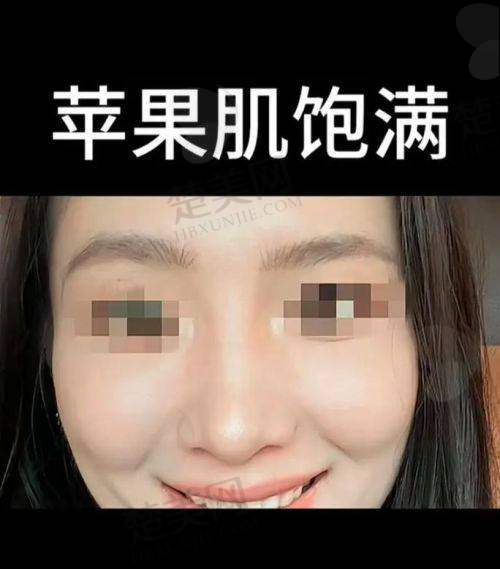 三、注射填苹果肌的美学考量