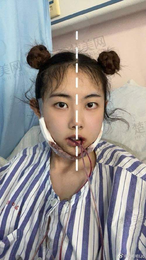 六、广州王涛正颌手术患者评价及实例