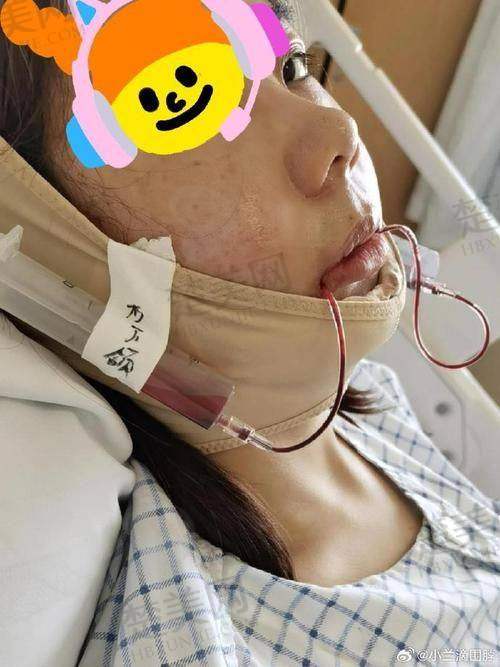 二、薛国初局麻正颌的优势