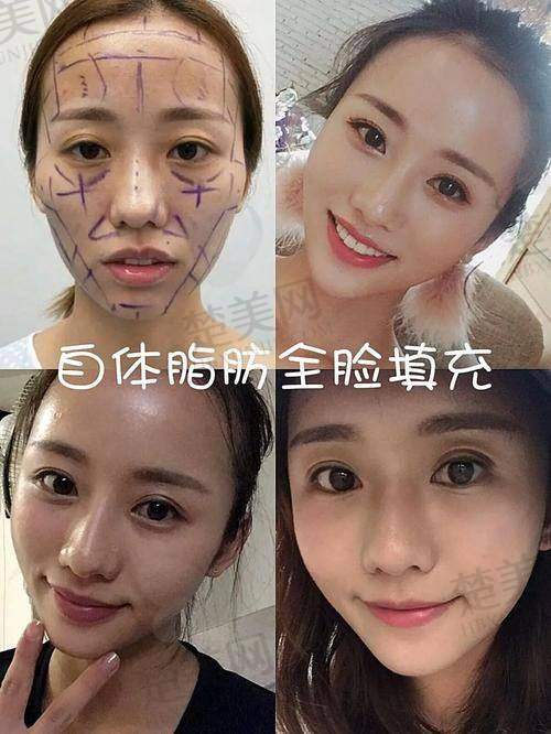 五、王明利医生做脂肪填充好吗？看行业认可度
