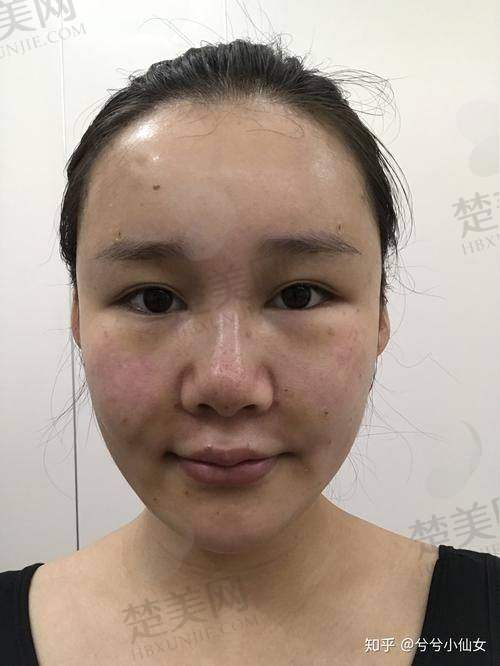 五、如何挑选哈尔滨脂肪填充医生