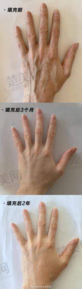一、王世虎医生——广州军美医疗美容的脂肪填充大师