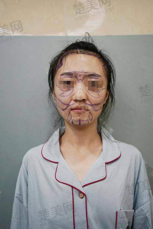 二、王明利医生做脂肪填充好吗？看技术优势亮点