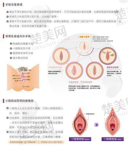六、韩国阴唇整形医院推荐