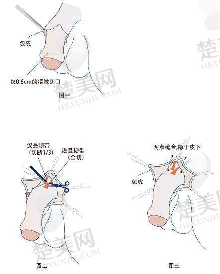 六、芜湖二四美医疗美容门诊部：芜湖玻尿酸男性增大注射要多少钱一次呢