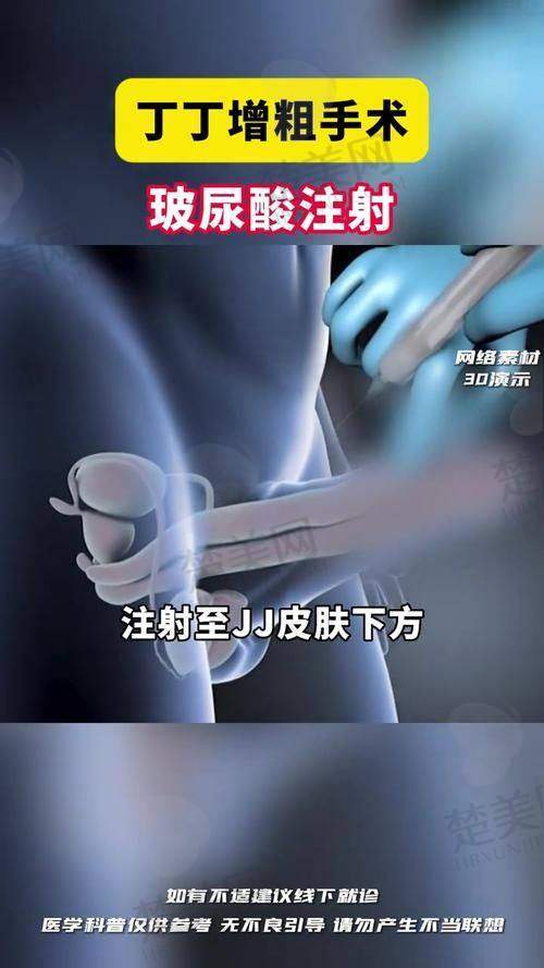 二、芜湖壹加壹整形：芜湖玻尿酸男性增大注射要多少钱一次呢