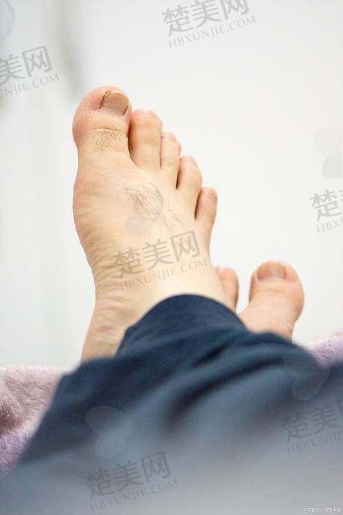 四、苏敬达大脚骨手术修复过程