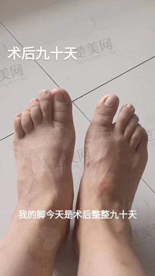 三、苏敬达做大脚骨手术费用多少
