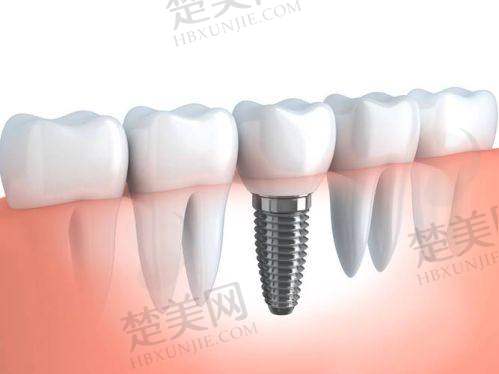四、西安美奥口腔——疑难种牙有保护