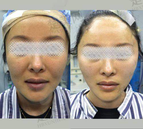 二、上海星璨李海涛筋膜大拉皮的四大独特优势