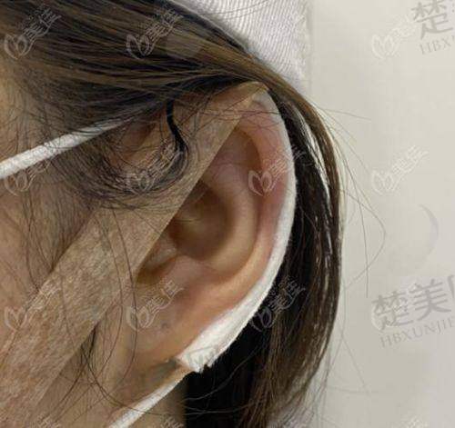 三、余文林医生唇裂修复的精妙技巧