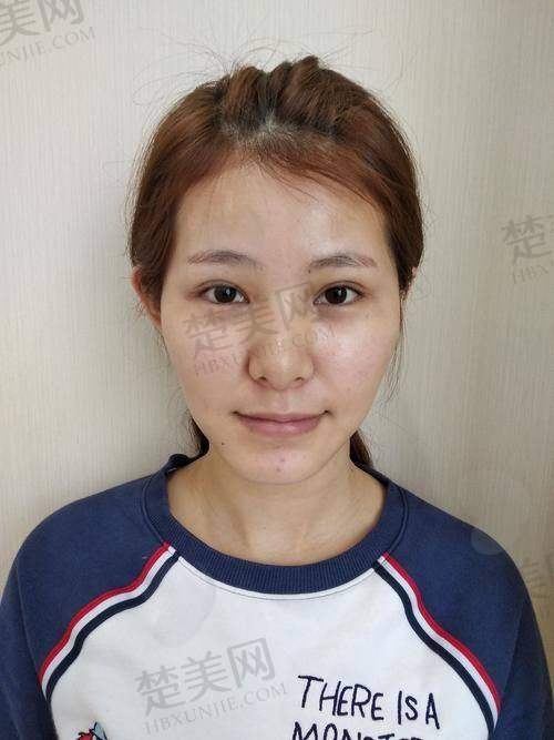 二、影响自体面部脂肪填充费用的核心因素